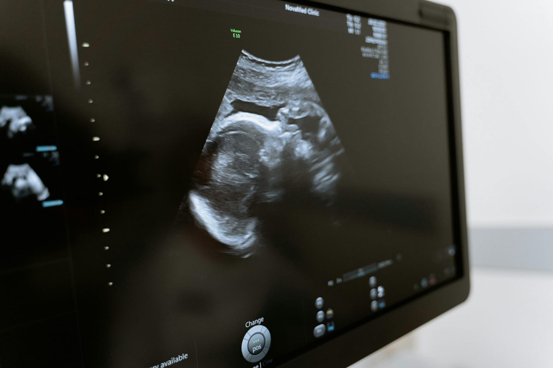 Ultrasound screen