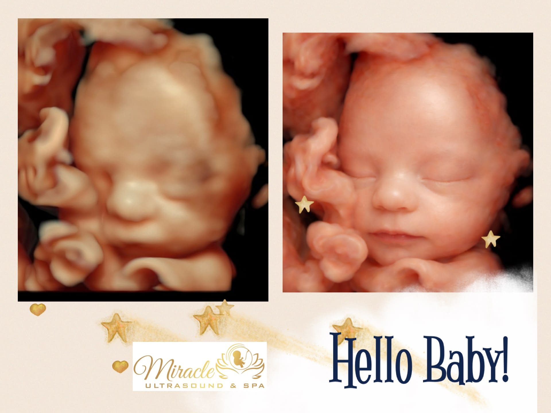 miracle-ultrasound-and-spa-baby-ultrasound-before-and-after-6