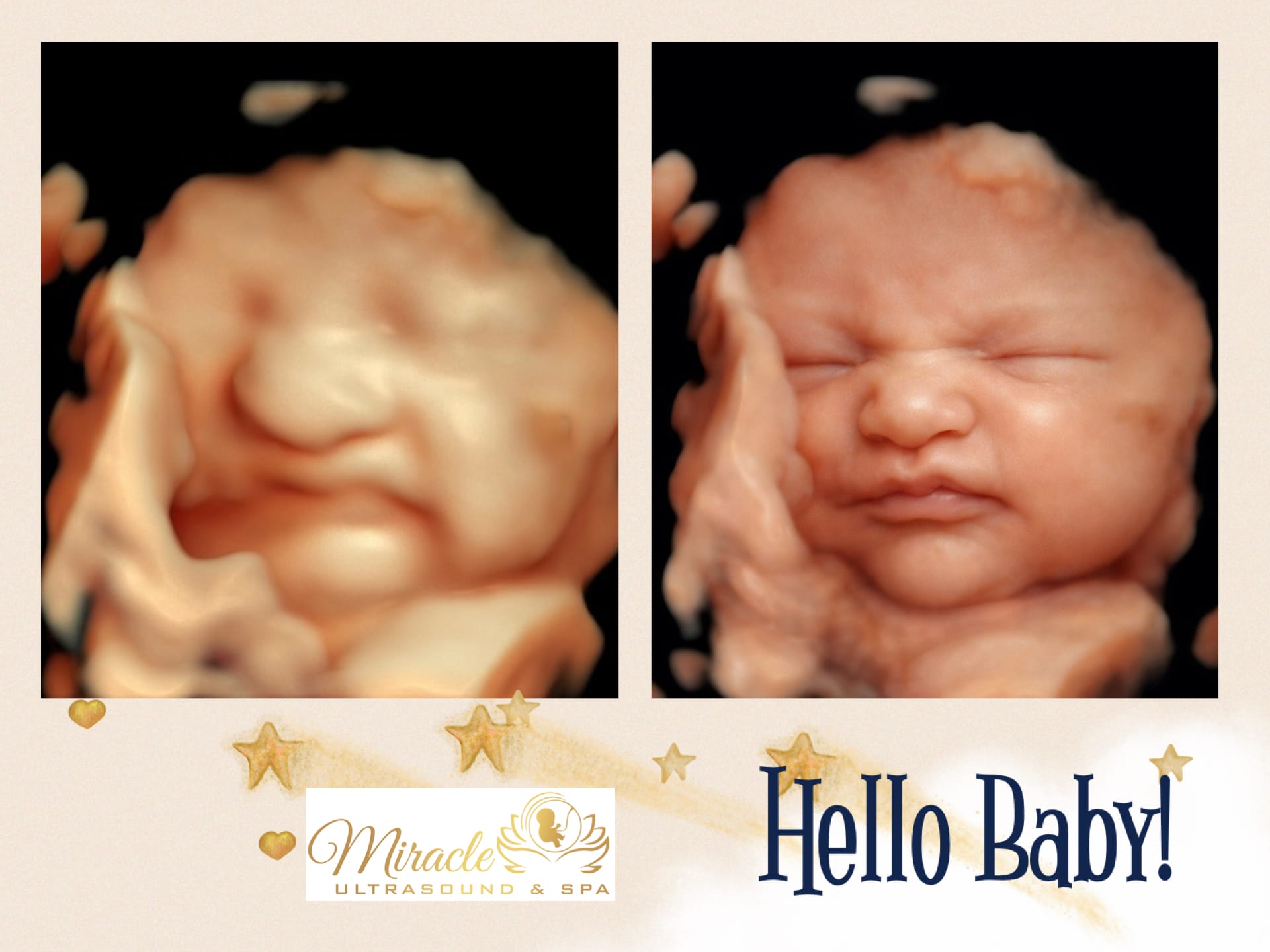 miracle-ultrasound-and-spa-baby-ultrasound-before-and-after-22