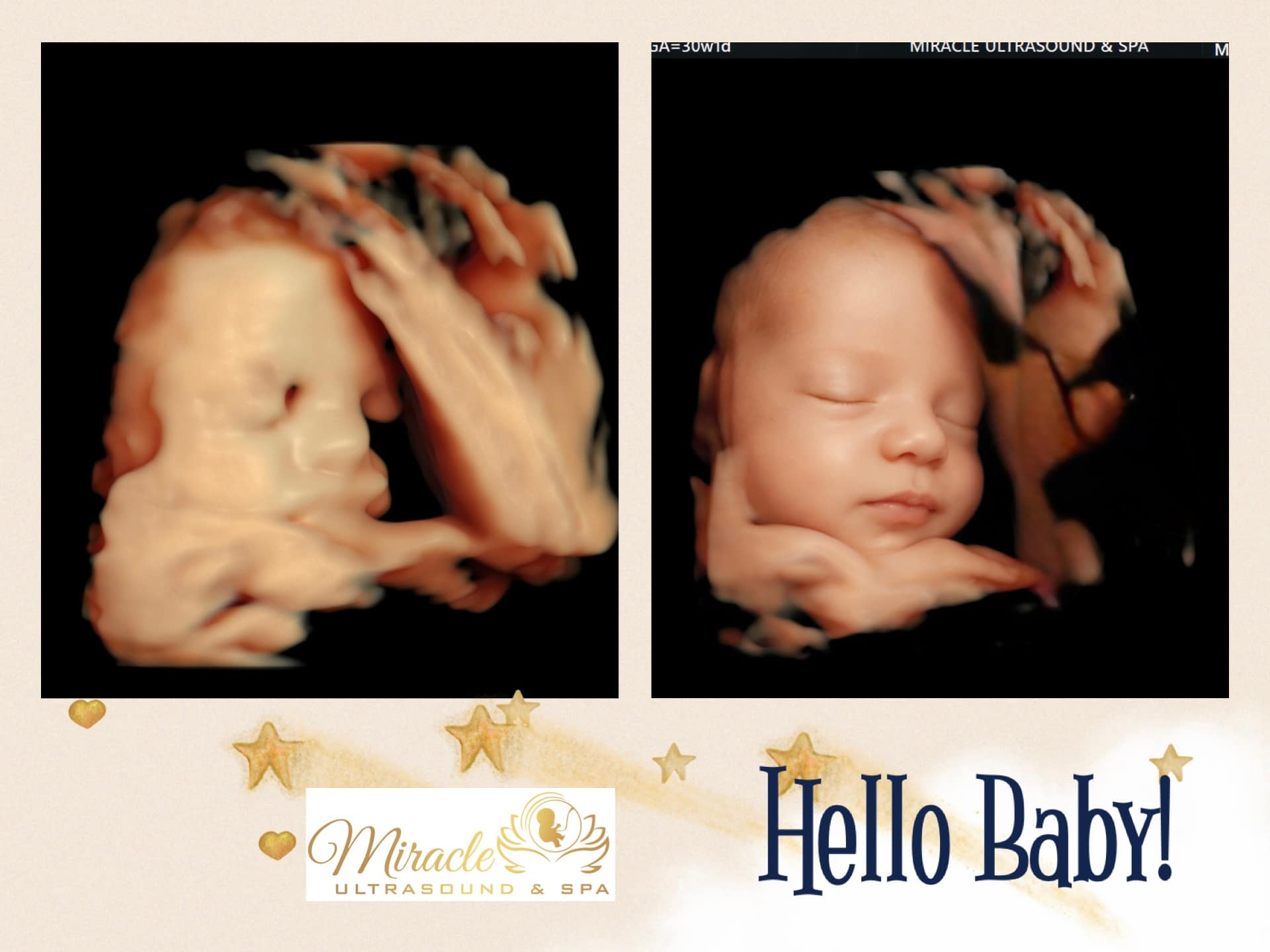 miracle-ultrasound-and-spa-baby-ultrasound-before-and-after-29