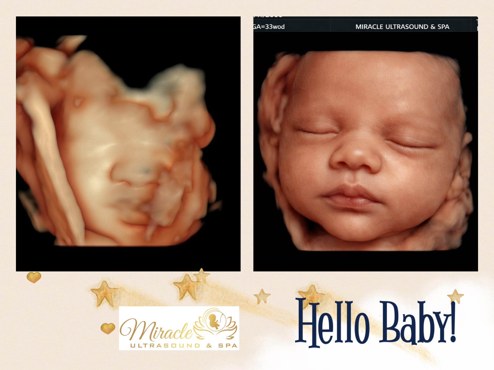 miracle-ultrasound-and-spa-baby-ultrasound-before-and-after-19